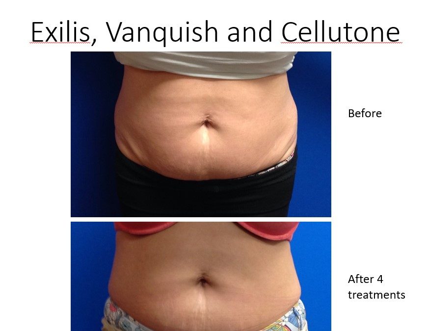 Best fat reduction without surgery center in Charlotte for its residents.