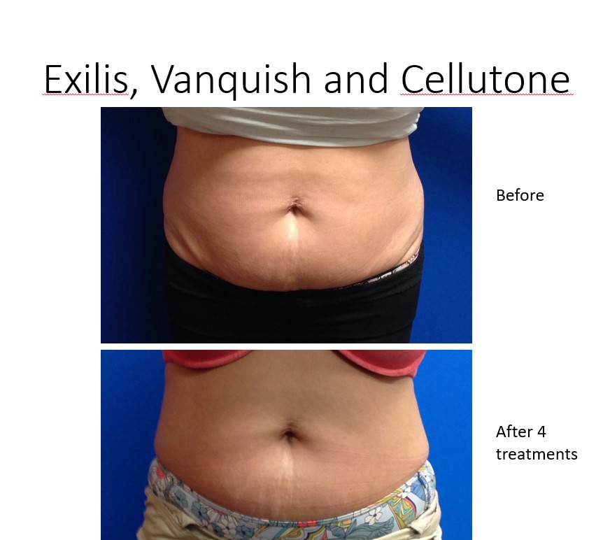 Body contouring benefits for Charlotte, NC patients from top dermatologist