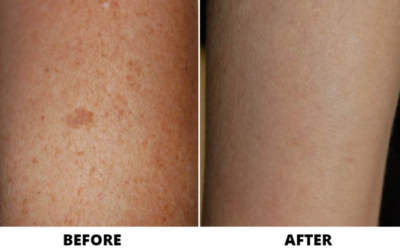 BBL treatments for desired skin results: Top Ballantyne Dermatologist